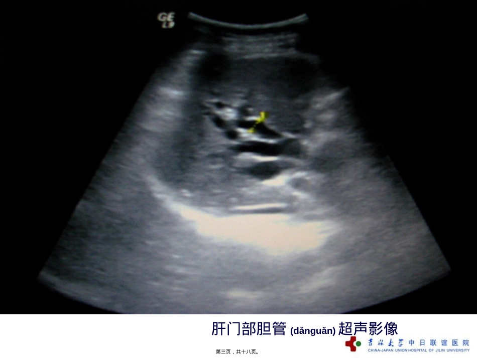莫西沙星病例分享.ppt（大秘书文库）_第3页