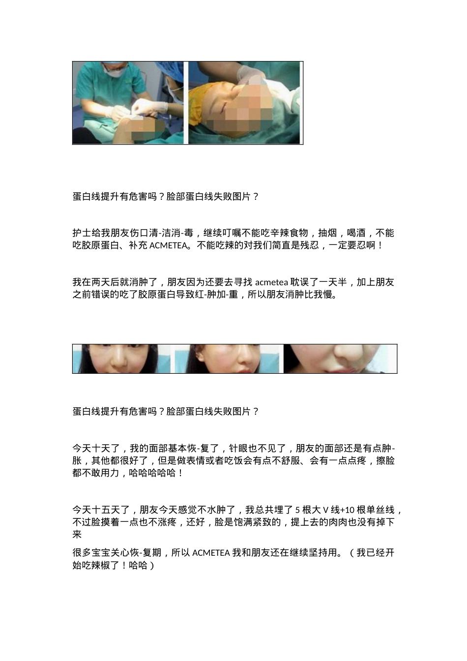 蛋白线提升有危害吗？脸部蛋白线失败图片？.doc_第2页