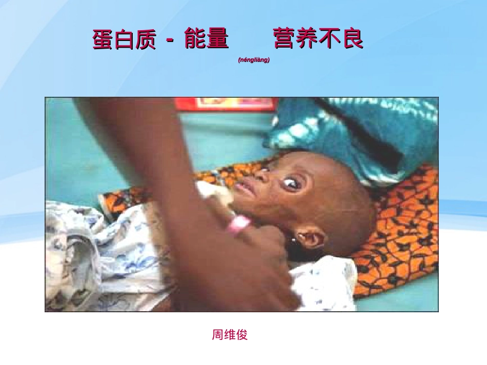 蛋白质-营养不良.ppt_第1页